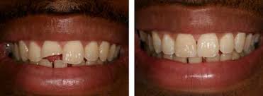 Broken teeth treatment Trivandrum Kerala
