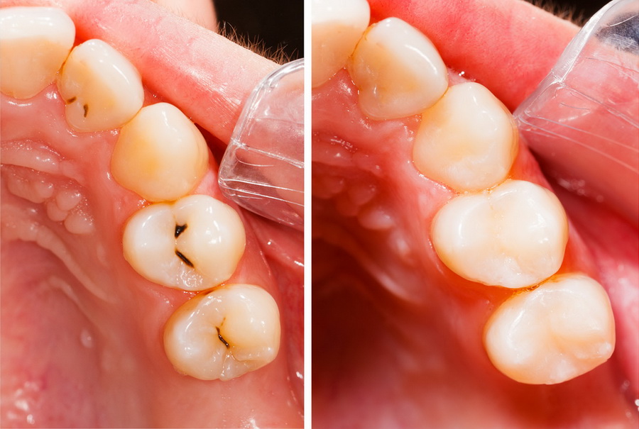 Composite Fillings Teeth Colored Trivandrum