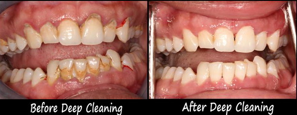 deep cleaning treatment