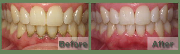 Periodontal cleaning treatment