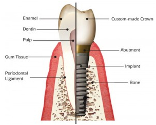 Dental Implants Trivandrum