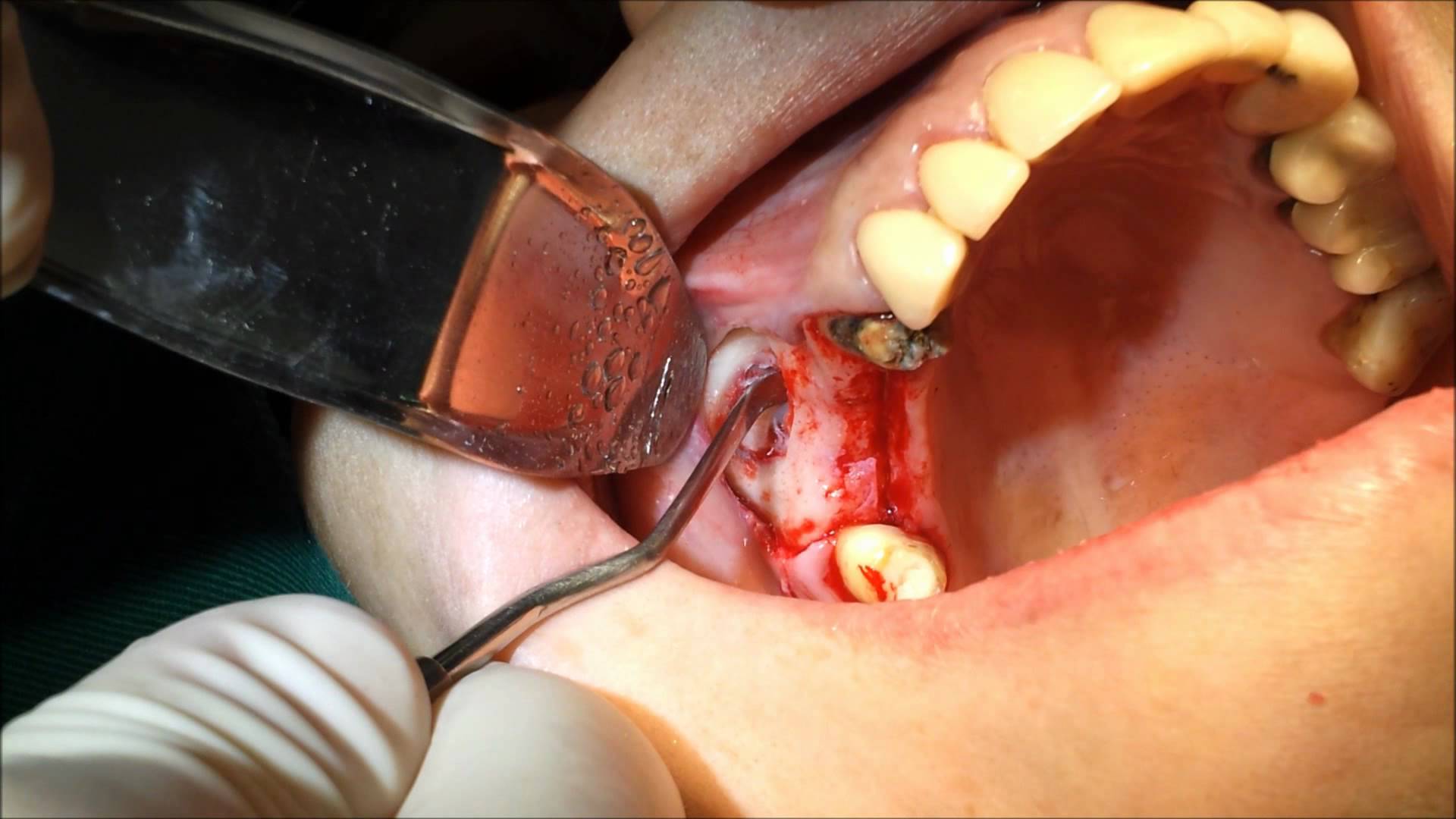 Sinus Lift Surgery Procedure Trivandrum