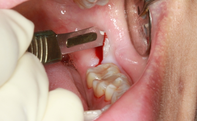 Surgical Removal of Impacted Teeth Trivandrum