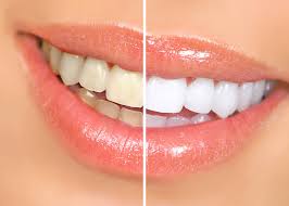 Teeth Whitening Trivandrum