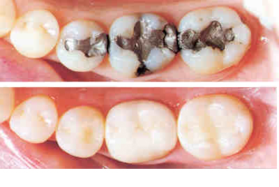 Dental Fillings treatment
